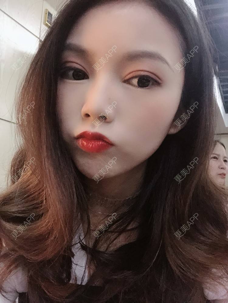 更美 - 更美用户T3PhxaY9Vo的玻尿酸下巴经验 | 广州 | 视频日记 | 玻尿酸下巴