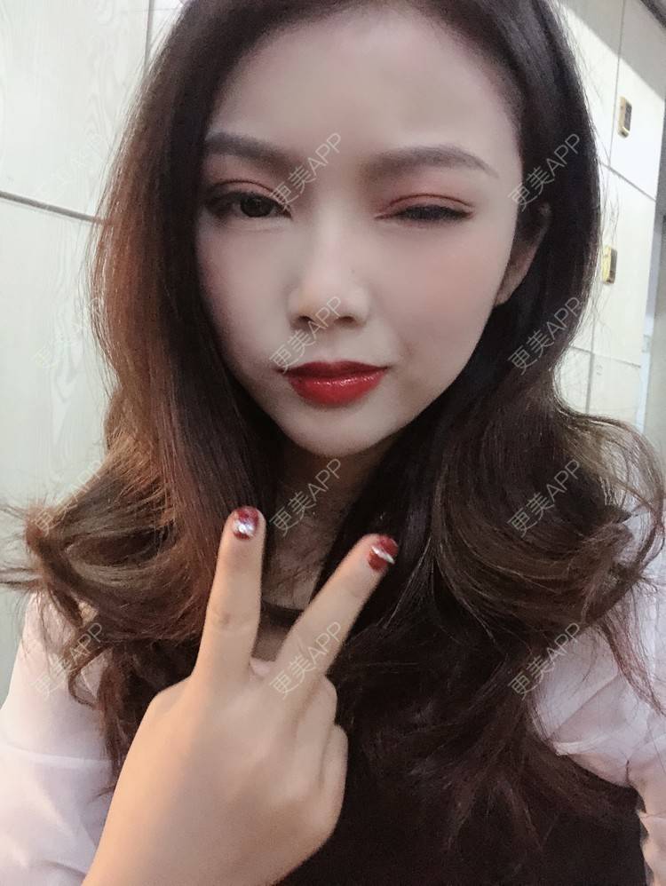 更美 - 更美用户T3PhxaY9Vo的玻尿酸下巴经验 | 广州 | 视频日记 | 玻尿酸下巴