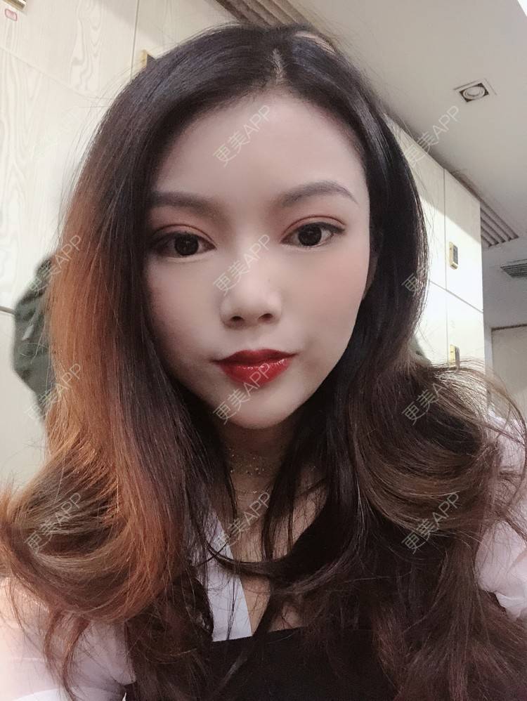 更美 - 更美用户T3PhxaY9Vo的玻尿酸下巴经验 | 广州 | 视频日记 | 玻尿酸下巴