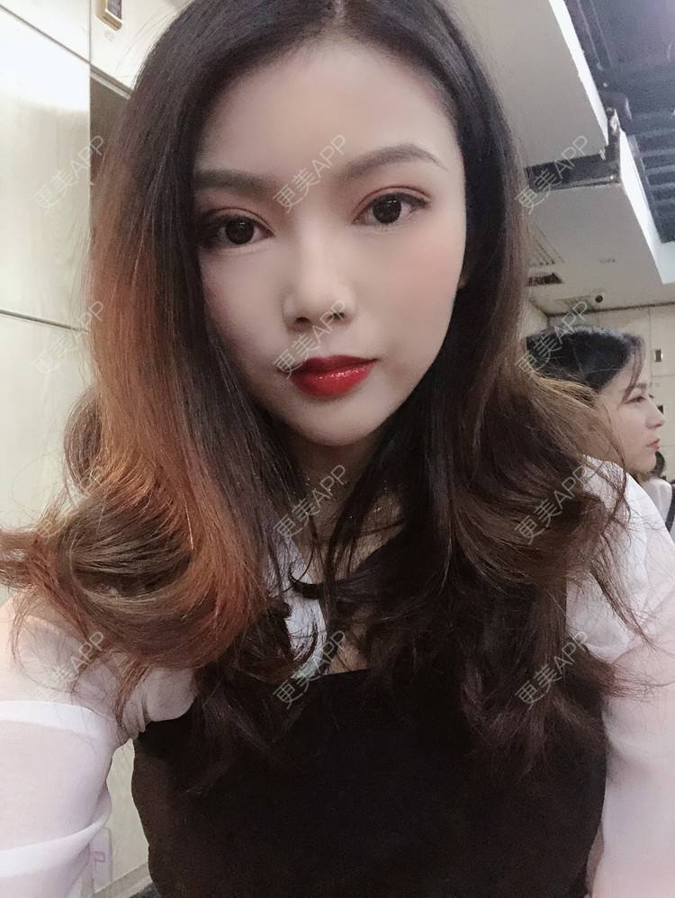 更美 - 更美用户T3PhxaY9Vo的玻尿酸下巴经验 | 广州 | 视频日记 | 玻尿酸下巴