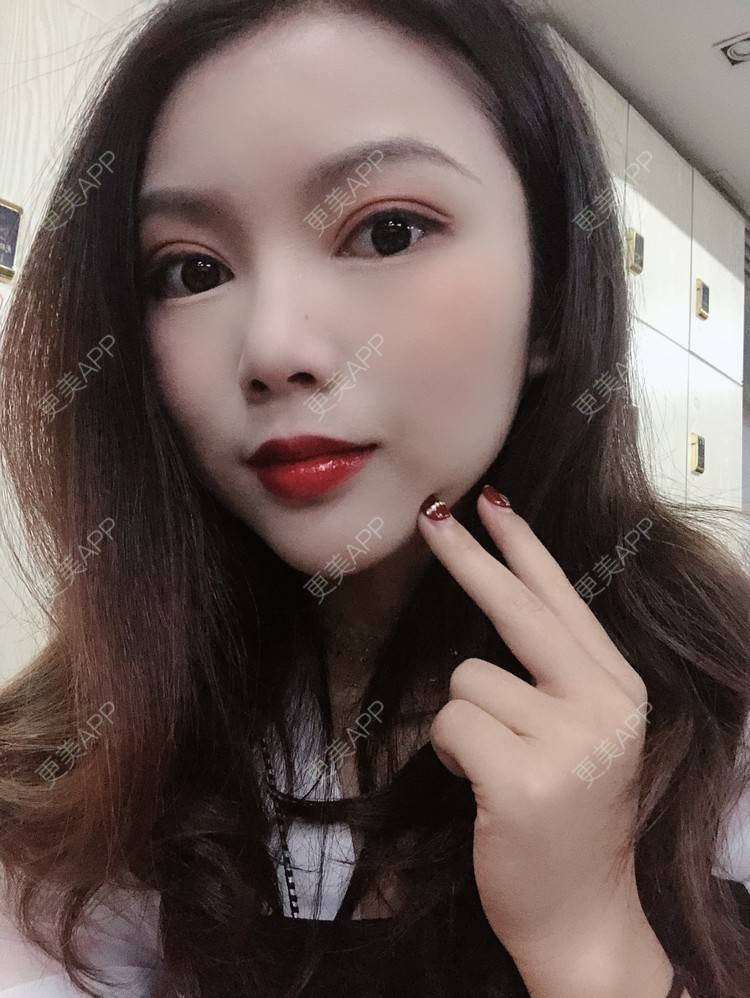 更美 - 更美用户T3PhxaY9Vo的玻尿酸下巴经验 | 广州 | 视频日记 | 玻尿酸下巴