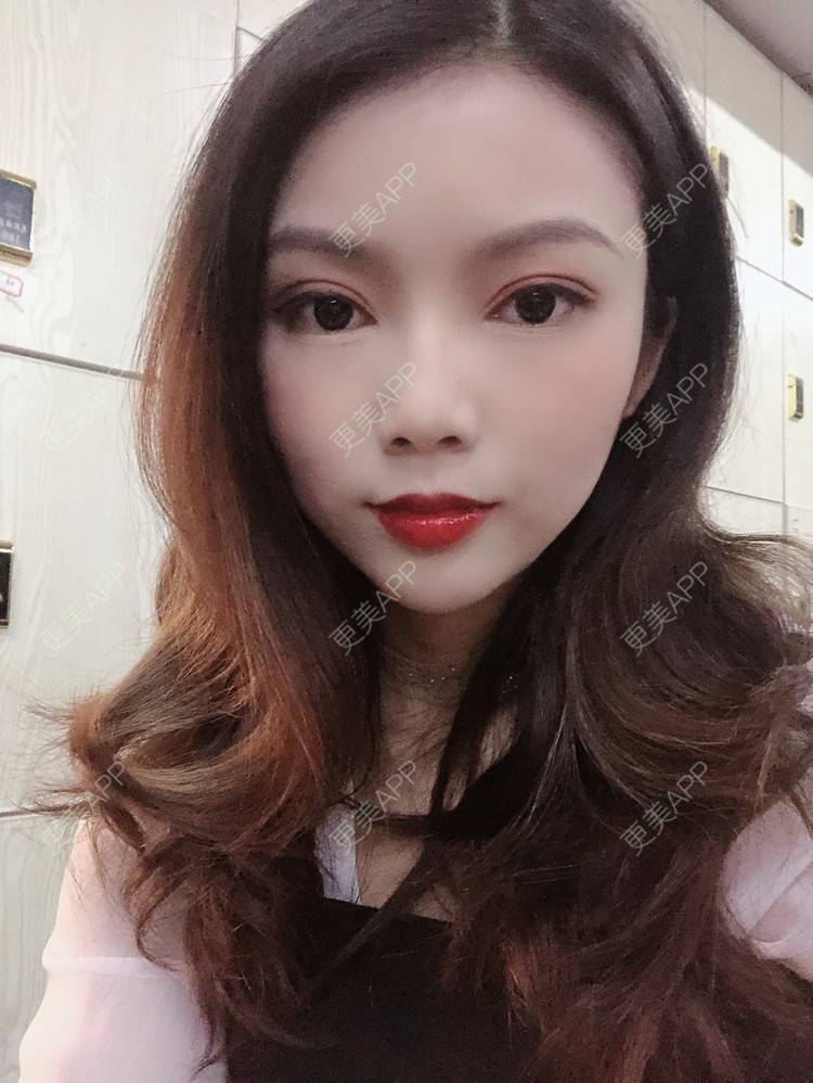 更美 - 更美用户T3PhxaY9Vo的玻尿酸下巴经验 | 广州 | 视频日记 | 玻尿酸下巴