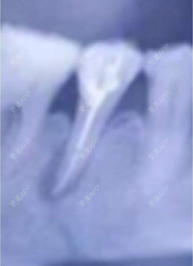更美 - 更美用户amyZHbrzsl的根管治疗经验 | 上海 | 根管治疗