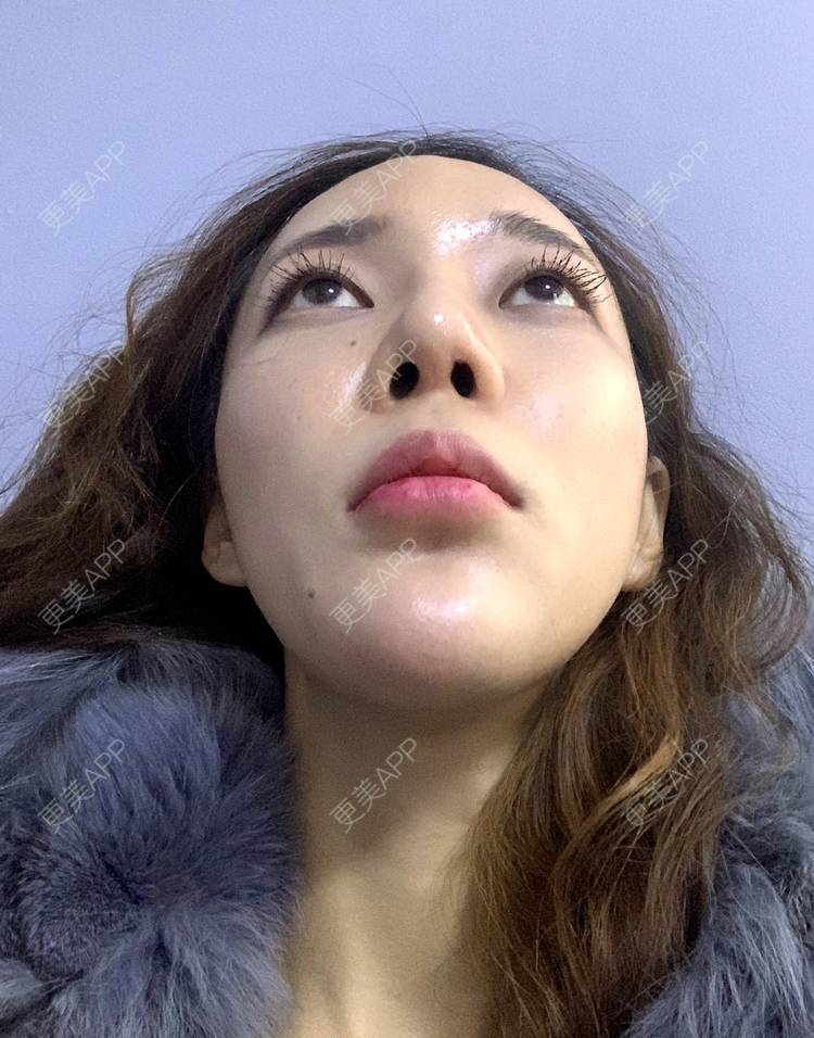 更美用户exblGQ6y2s的假体垫鼻基底