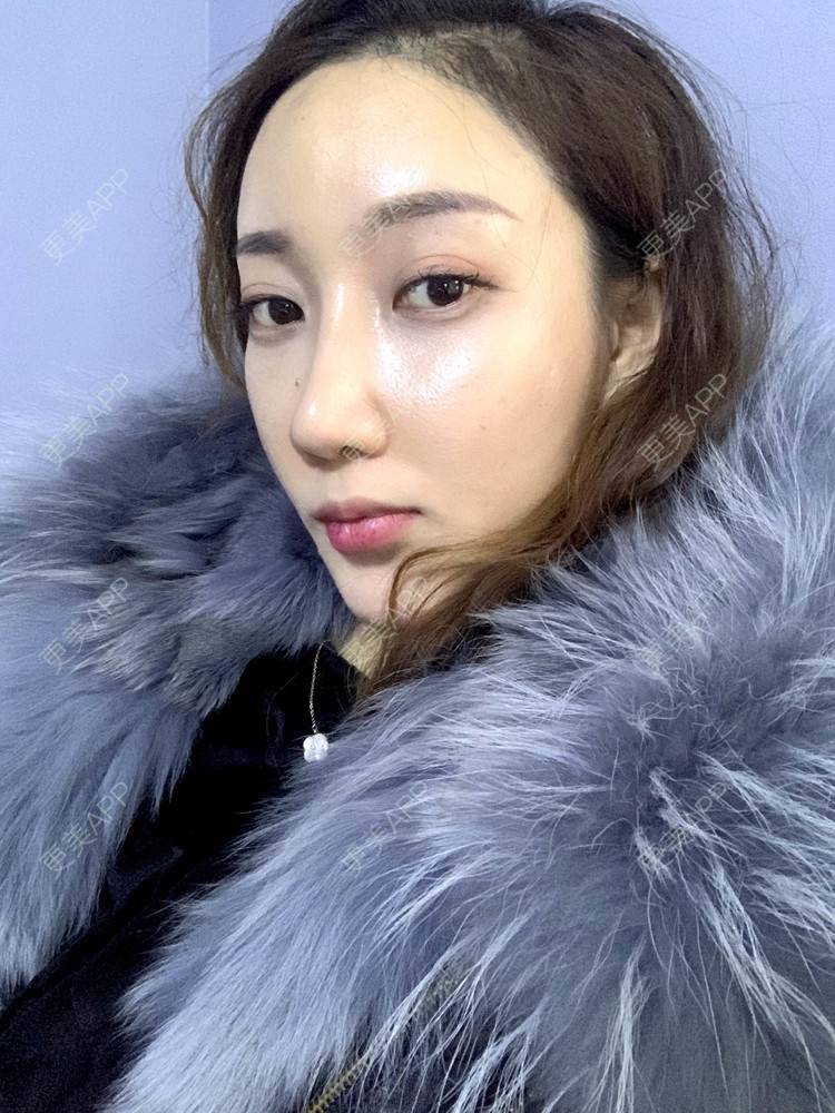 更美用户exblGQ6y2s的假体垫鼻基底