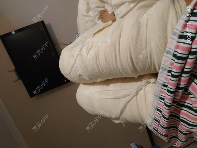 更美 - 更美用户WFzD4DOKgO的自体脂肪填充泪沟经验 | 自体脂肪填充泪沟 | 自体脂肪丰苹果肌 | 自体脂肪垫下巴 | 自体脂肪丰太阳穴 | 吸脂 | 成都