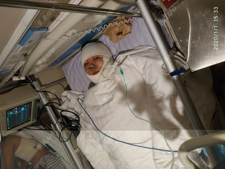 更美 - 更美用户WFzD4DOKgO的自体脂肪填充泪沟经验 | 自体脂肪填充泪沟 | 自体脂肪丰苹果肌 | 自体脂肪垫下巴 | 自体脂肪丰太阳穴 | 吸脂 | 成都