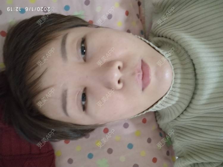 更美 - 更美用户WFzD4DOKgO的自体脂肪填充泪沟经验 | 自体脂肪填充泪沟 | 自体脂肪丰苹果肌 | 自体脂肪垫下巴 | 自体脂肪丰太阳穴 | 吸脂 | 成都