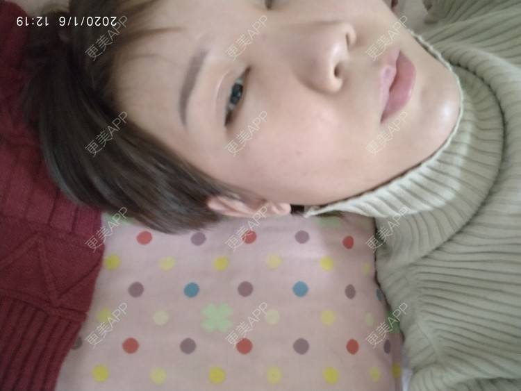 更美 - 更美用户WFzD4DOKgO的自体脂肪填充泪沟经验 | 自体脂肪填充泪沟 | 自体脂肪丰苹果肌 | 自体脂肪垫下巴 | 自体脂肪丰太阳穴 | 吸脂 | 成都