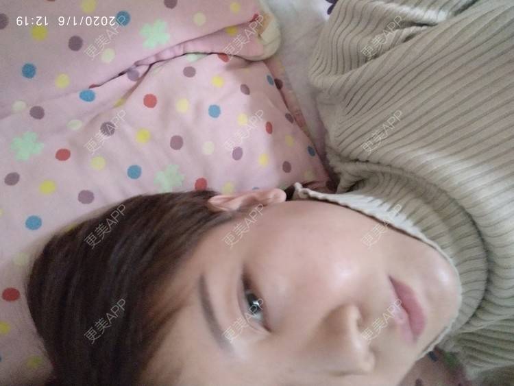 更美 - 更美用户WFzD4DOKgO的自体脂肪填充泪沟经验 | 自体脂肪填充泪沟 | 自体脂肪丰苹果肌 | 自体脂肪垫下巴 | 自体脂肪丰太阳穴 | 吸脂 | 成都