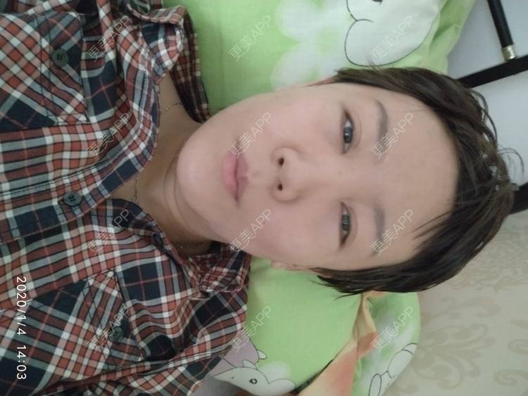 更美 - 更美用户WFzD4DOKgO的自体脂肪填充泪沟经验 | 自体脂肪填充泪沟 | 自体脂肪丰苹果肌 | 自体脂肪垫下巴 | 自体脂肪丰太阳穴 | 吸脂 | 成都