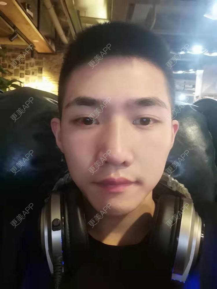 更美 - 仰望ooo的驼峰鼻矫正经验 | 北京 | 视频日记 | 驼峰鼻矫正