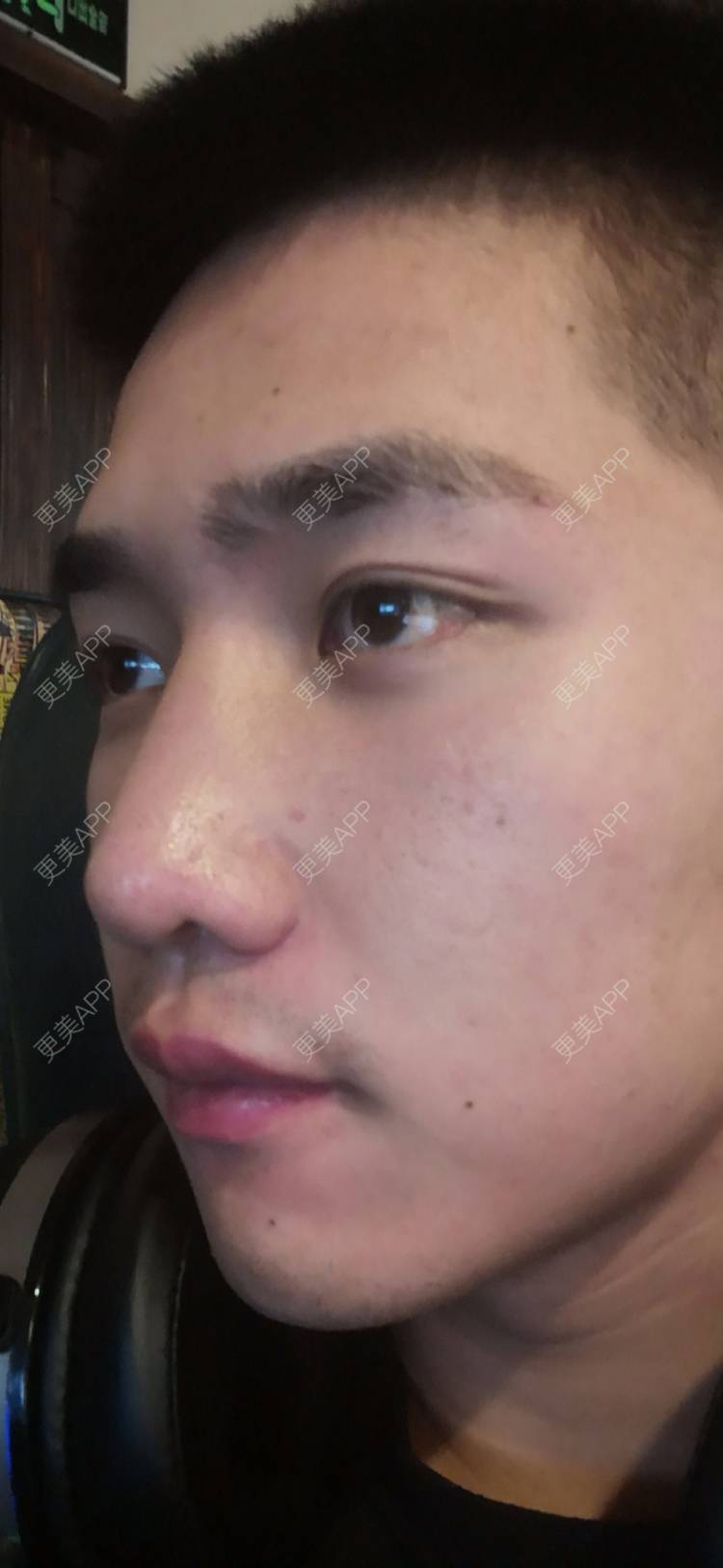 更美 - 仰望ooo的驼峰鼻矫正经验 | 北京 | 视频日记 | 驼峰鼻矫正