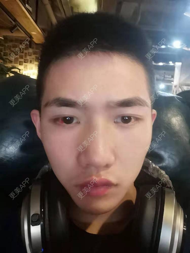 更美 - 仰望ooo的驼峰鼻矫正经验 | 北京 | 视频日记 | 驼峰鼻矫正