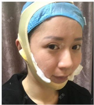 更美用户2gpjqdhncz的下颌角切除术日记