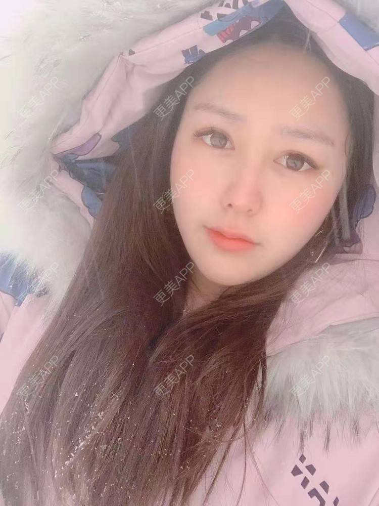 更美 - 更美用户dapPewZ45A的自体脂肪丰额头经验 | 视频日记 | 自体脂肪丰额头 | 重庆