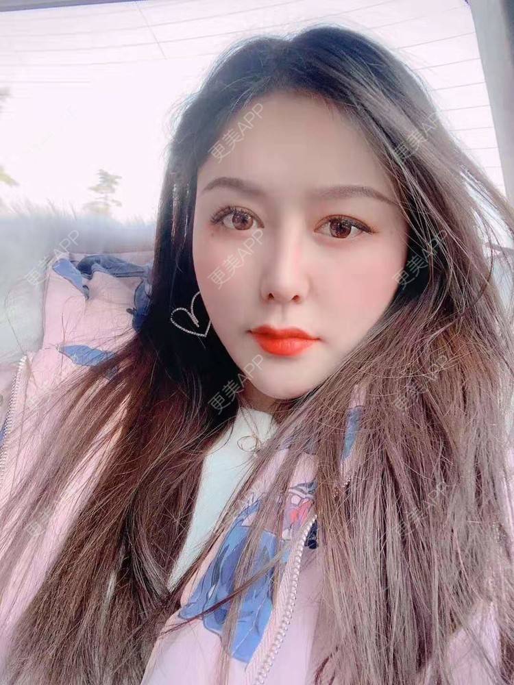 更美 - 更美用户dapPewZ45A的自体脂肪丰额头经验 | 视频日记 | 自体脂肪丰额头 | 重庆