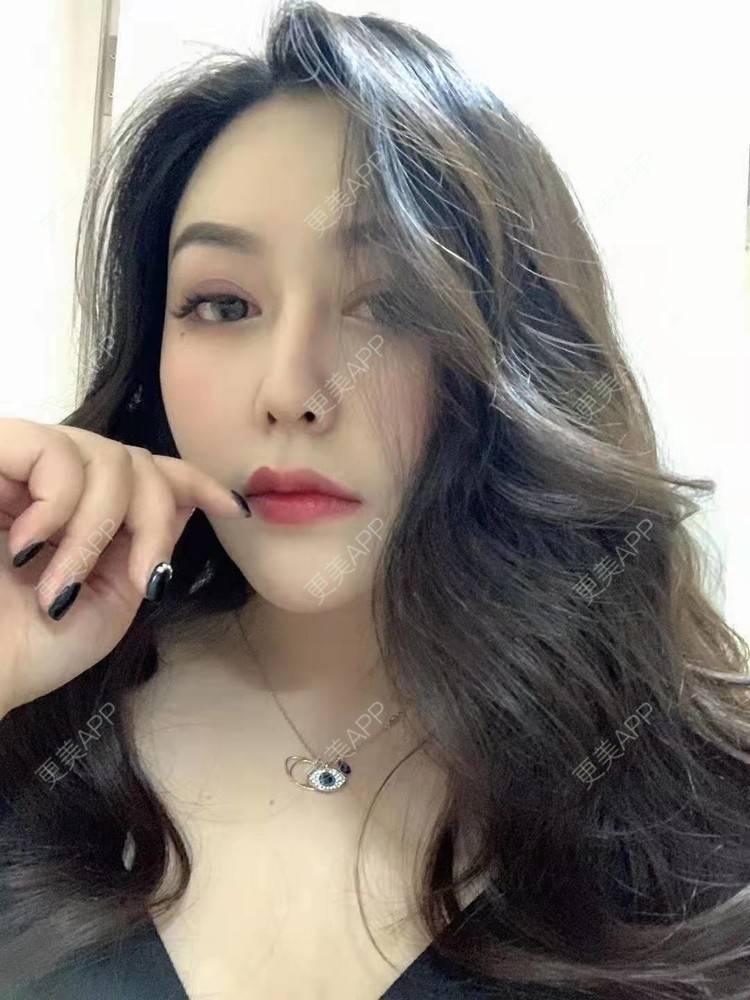 更美 - 更美用户dapPewZ45A的自体脂肪丰额头经验 | 视频日记 | 自体脂肪丰额头 | 重庆