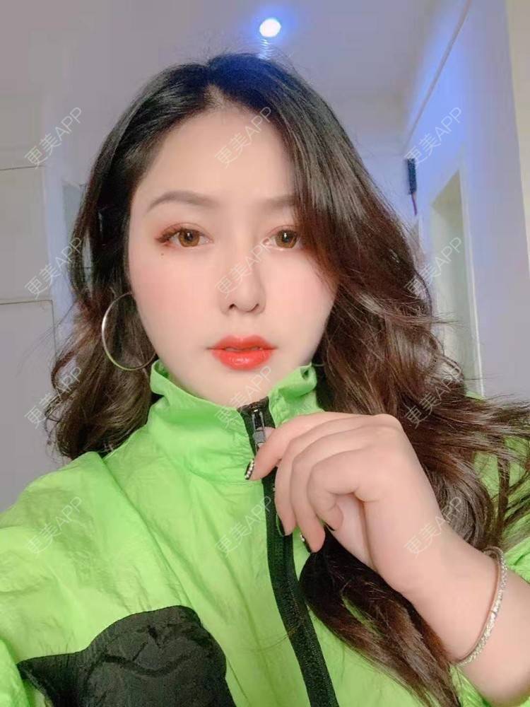 更美 - 更美用户dapPewZ45A的自体脂肪丰额头经验 | 视频日记 | 自体脂肪丰额头 | 重庆