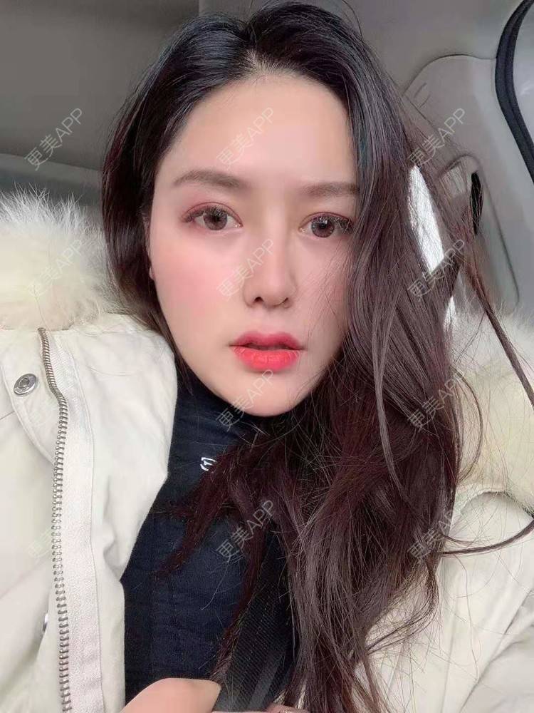 更美 - 更美用户dapPewZ45A的自体脂肪丰额头经验 | 视频日记 | 自体脂肪丰额头 | 重庆