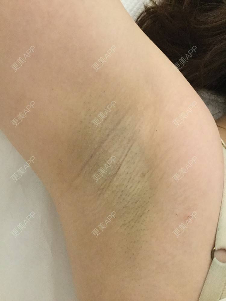 更美 - 一朵花🧚‍♀️的激光脱腋毛经验 | 激光脱腋毛 | 北京