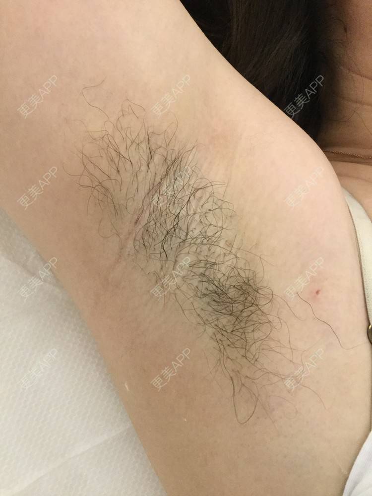 更美 - 一朵花🧚‍♀️的激光脱腋毛经验 | 激光脱腋毛 | 北京
