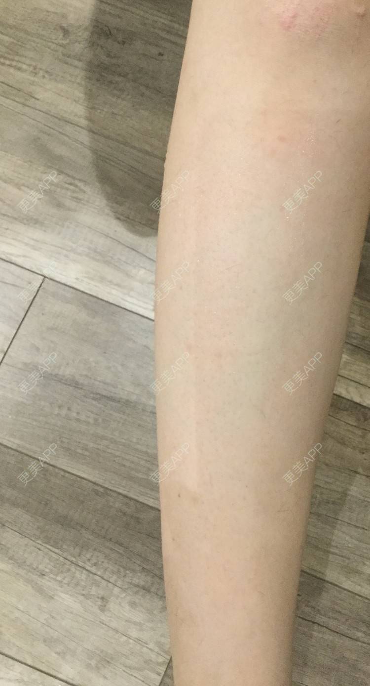 更美 - 一枚小可爱糖的大腿脱毛经验 | 大腿脱毛 | 北京