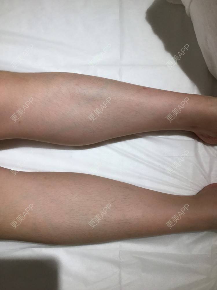 更美 - 一枚小可爱糖的大腿脱毛经验 | 大腿脱毛 | 北京