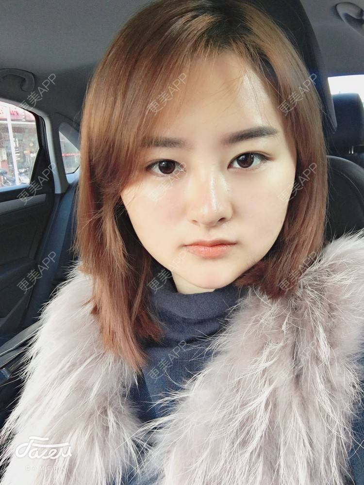 更美 - 浑身上下的肋软骨隆鼻经验 | 更美研究所 | 杭州 | 肋软骨隆鼻 | 隆鼻