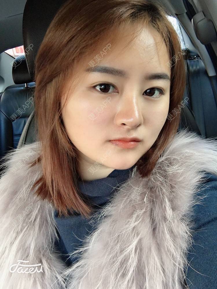 更美 - 浑身上下的肋软骨隆鼻经验 | 更美研究所 | 杭州 | 肋软骨隆鼻 | 隆鼻