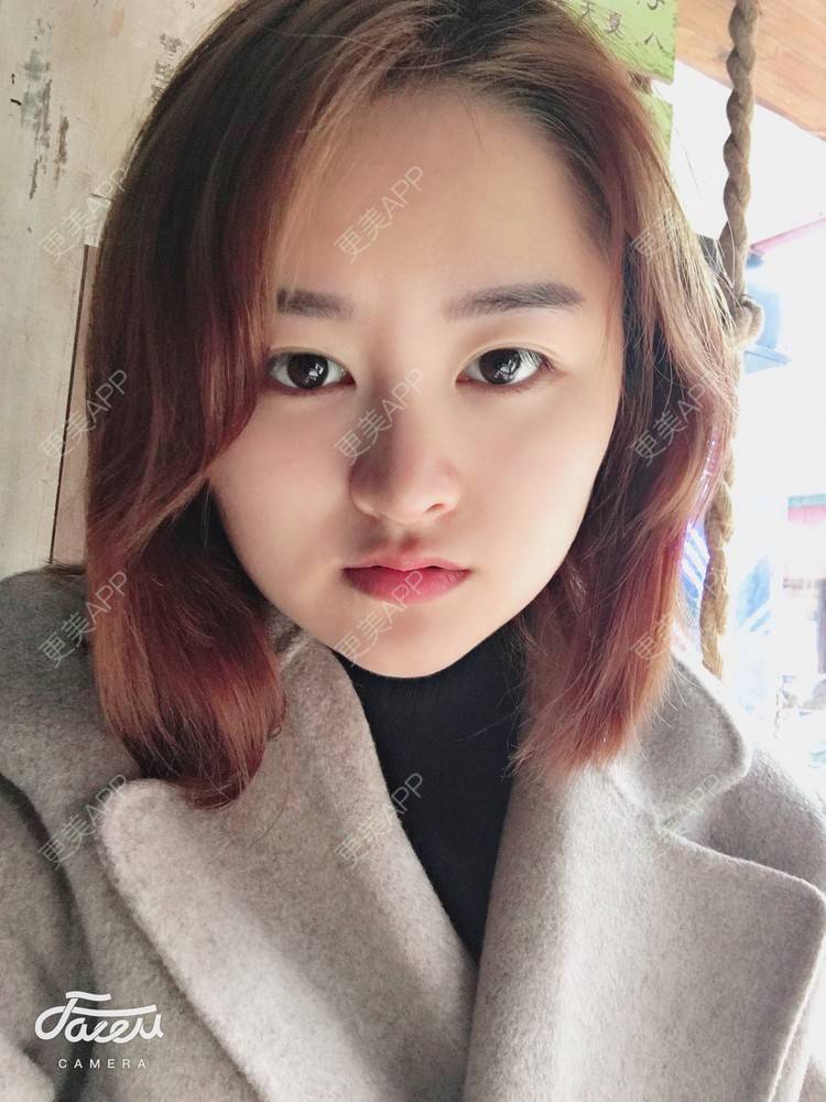 更美 - 浑身上下的肋软骨隆鼻经验 | 更美研究所 | 杭州 | 肋软骨隆鼻 | 隆鼻