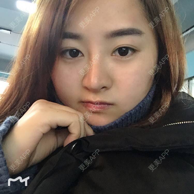 更美 - 浑身上下的肋软骨隆鼻经验 | 更美研究所 | 杭州 | 肋软骨隆鼻 | 隆鼻