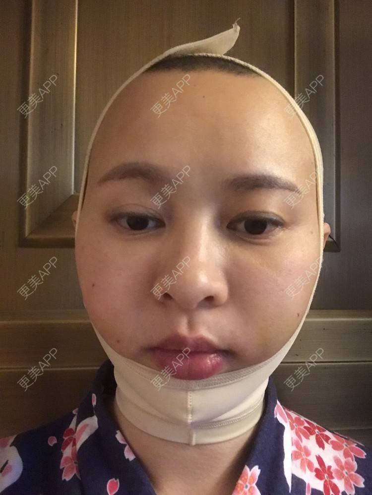 更美 - 更美用户ZSfIpAcDBn的腰腹吸脂经验 | 腰腹吸脂 | 背部吸脂 | 手臂吸脂 | 北京