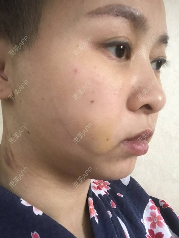 更美 - 更美用户ZSfIpAcDBn的腰腹吸脂经验 | 腰腹吸脂 | 背部吸脂 | 手臂吸脂 | 北京