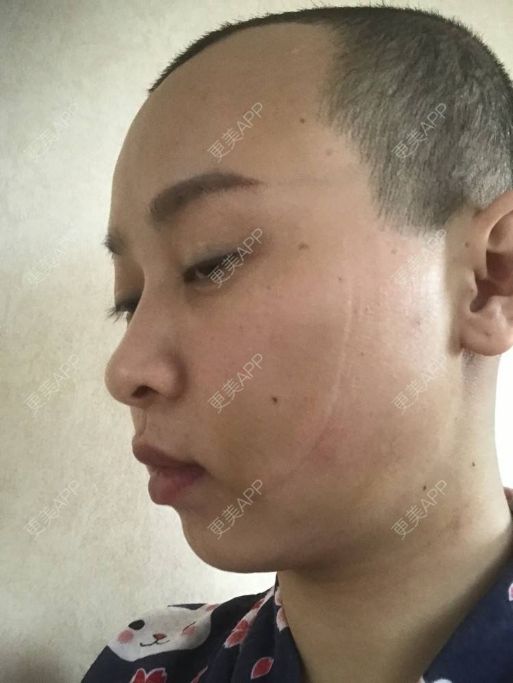 更美 - 更美用户ZSfIpAcDBn的腰腹吸脂经验 | 腰腹吸脂 | 背部吸脂 | 手臂吸脂 | 北京