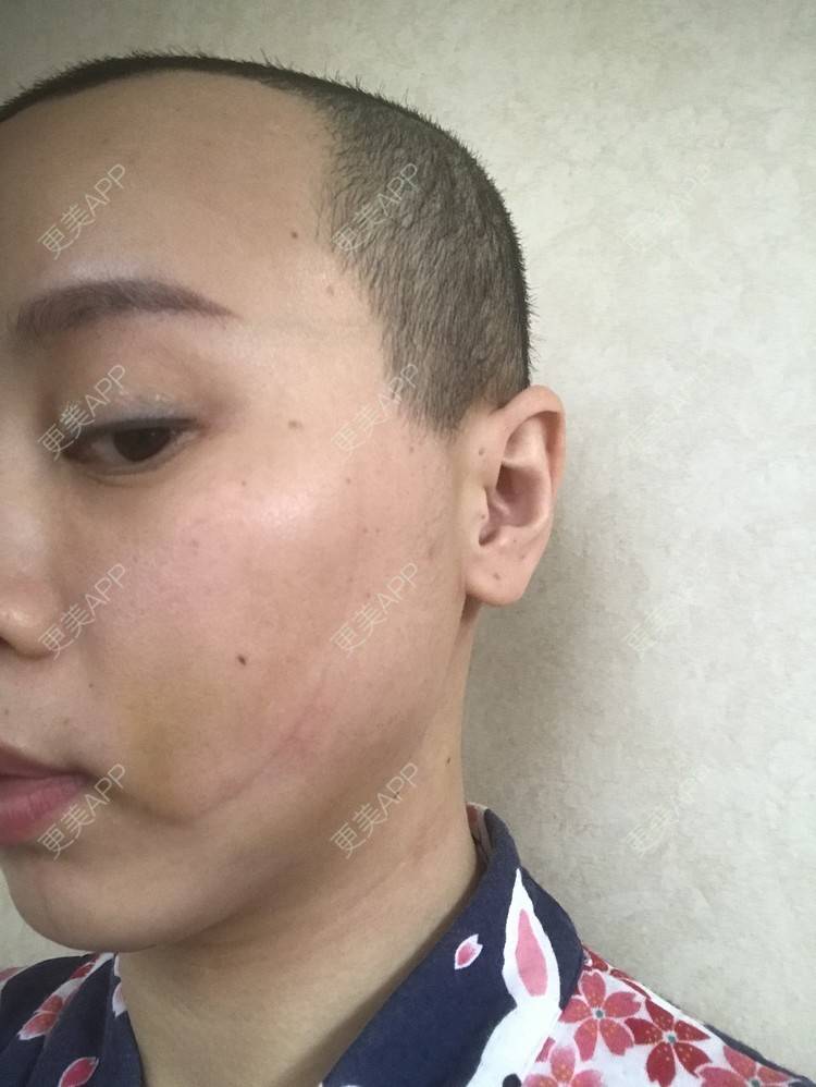 更美 - 更美用户ZSfIpAcDBn的腰腹吸脂经验 | 腰腹吸脂 | 背部吸脂 | 手臂吸脂 | 北京