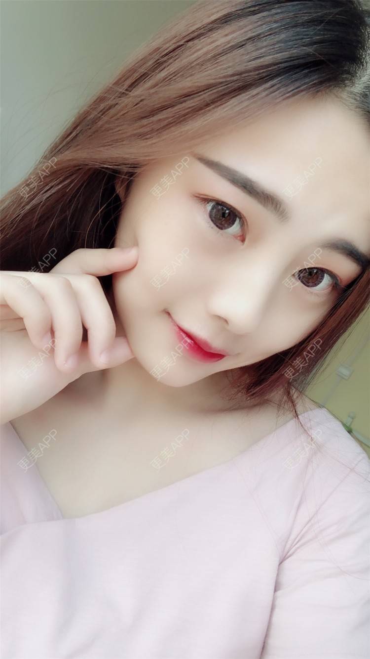 更美 - 小曹啊的鼻部多项经验 | 鼻部多项 | 鼻部修复 | 硅胶隆鼻 | 武汉