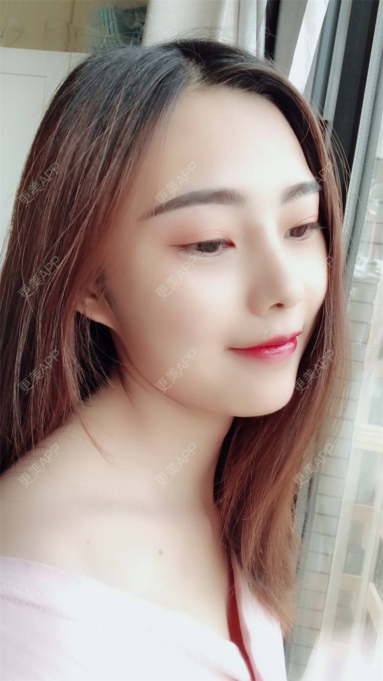 更美 - 小曹啊的鼻部多项经验 | 鼻部多项 | 鼻部修复 | 硅胶隆鼻 | 武汉