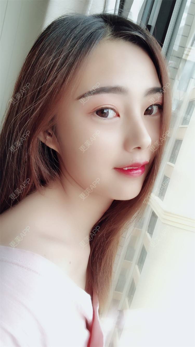 更美 - 小曹啊的鼻部多项经验 | 鼻部多项 | 鼻部修复 | 硅胶隆鼻 | 武汉