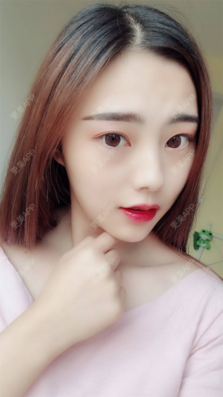 更美 - 小曹啊的鼻部多项经验 | 鼻部多项 | 鼻部修复 | 硅胶隆鼻 | 武汉