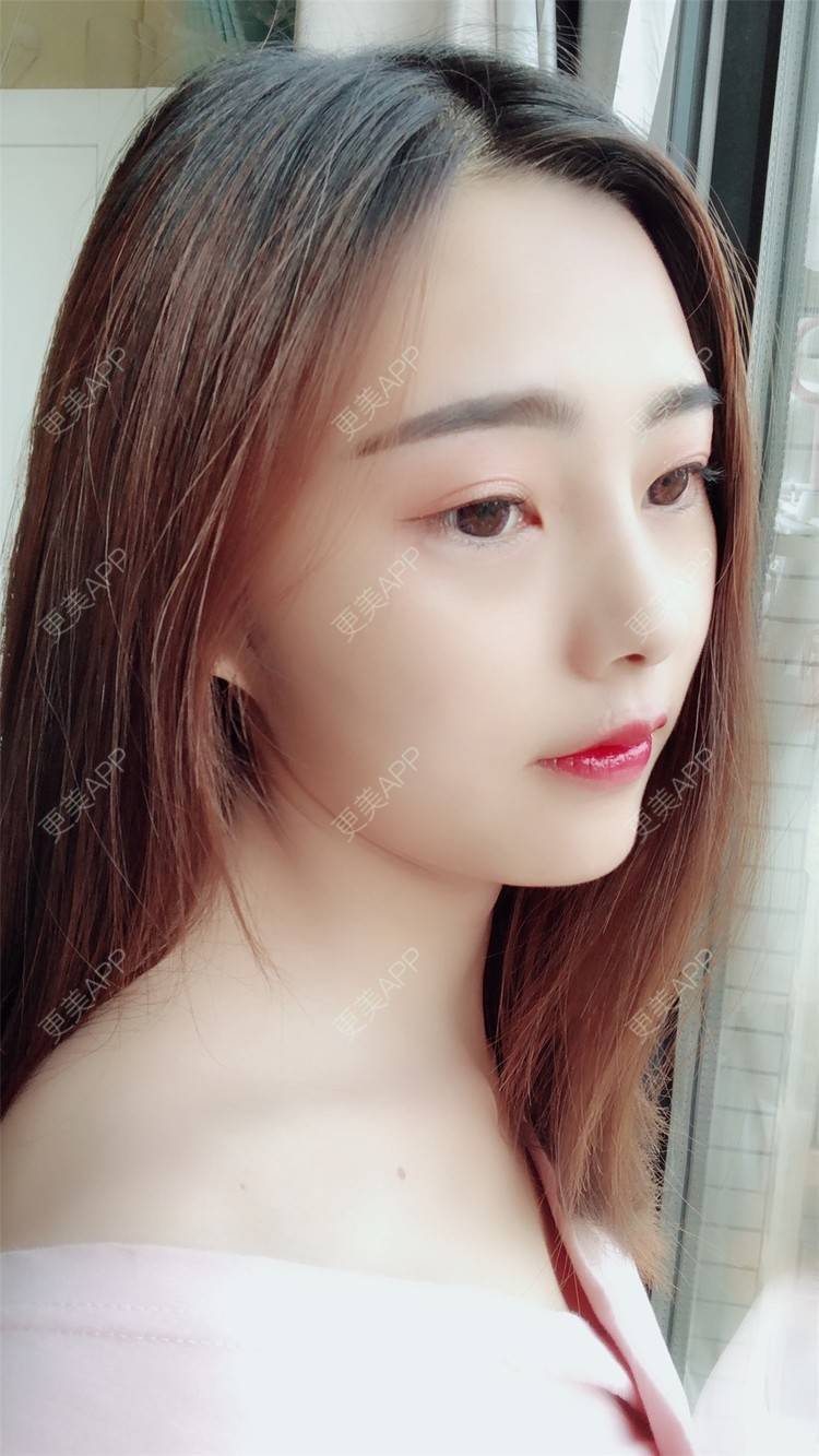 更美 - 小曹啊的鼻部多项经验 | 鼻部多项 | 鼻部修复 | 硅胶隆鼻 | 武汉