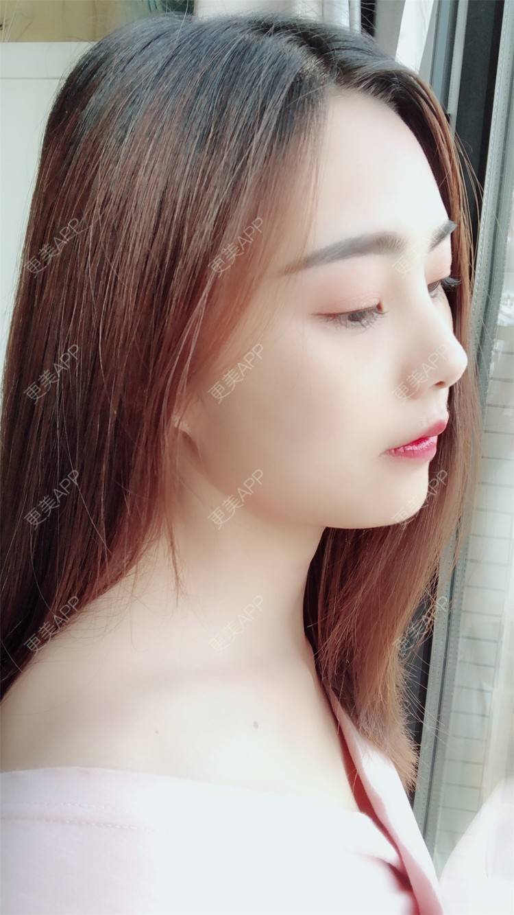 更美 - 小曹啊的鼻部多项经验 | 鼻部多项 | 鼻部修复 | 硅胶隆鼻 | 武汉