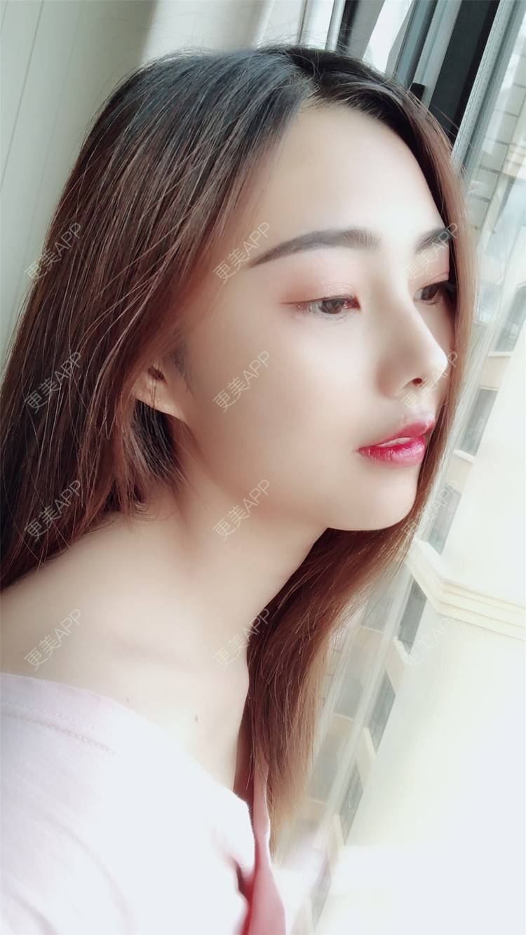 更美 - 小曹啊的鼻部多项经验 | 鼻部多项 | 鼻部修复 | 硅胶隆鼻 | 武汉