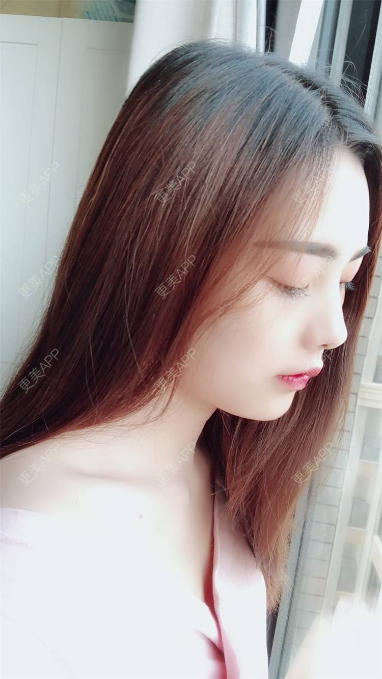 更美 - 小曹啊的鼻部多项经验 | 鼻部多项 | 鼻部修复 | 硅胶隆鼻 | 武汉