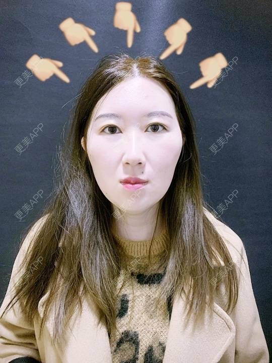 更美 - 郑曼曼曼的埋线提升经验 | 埋线提升 | 玻尿酸套餐