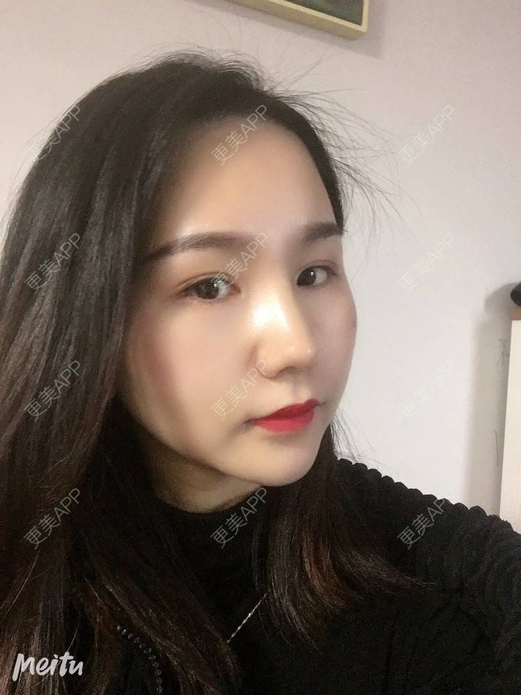 更美 - 怡你在这里吖的鼻部多项经验 | 耳软骨隆鼻 | 鼻翼缩小 | 鼻部多项 | 自体软骨垫鼻尖 | 重庆 | 鼻中隔软骨隆鼻