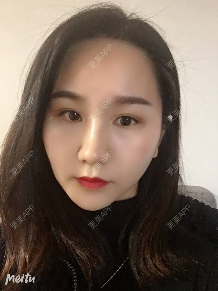 更美 - 怡你在这里吖的鼻部多项经验 | 耳软骨隆鼻 | 鼻翼缩小 | 鼻部多项 | 自体软骨垫鼻尖 | 重庆 | 鼻中隔软骨隆鼻