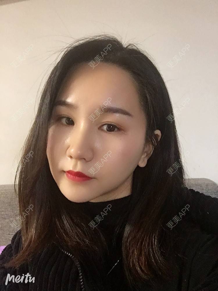 更美 - 怡你在这里吖的鼻部多项经验 | 耳软骨隆鼻 | 鼻翼缩小 | 鼻部多项 | 自体软骨垫鼻尖 | 重庆 | 鼻中隔软骨隆鼻