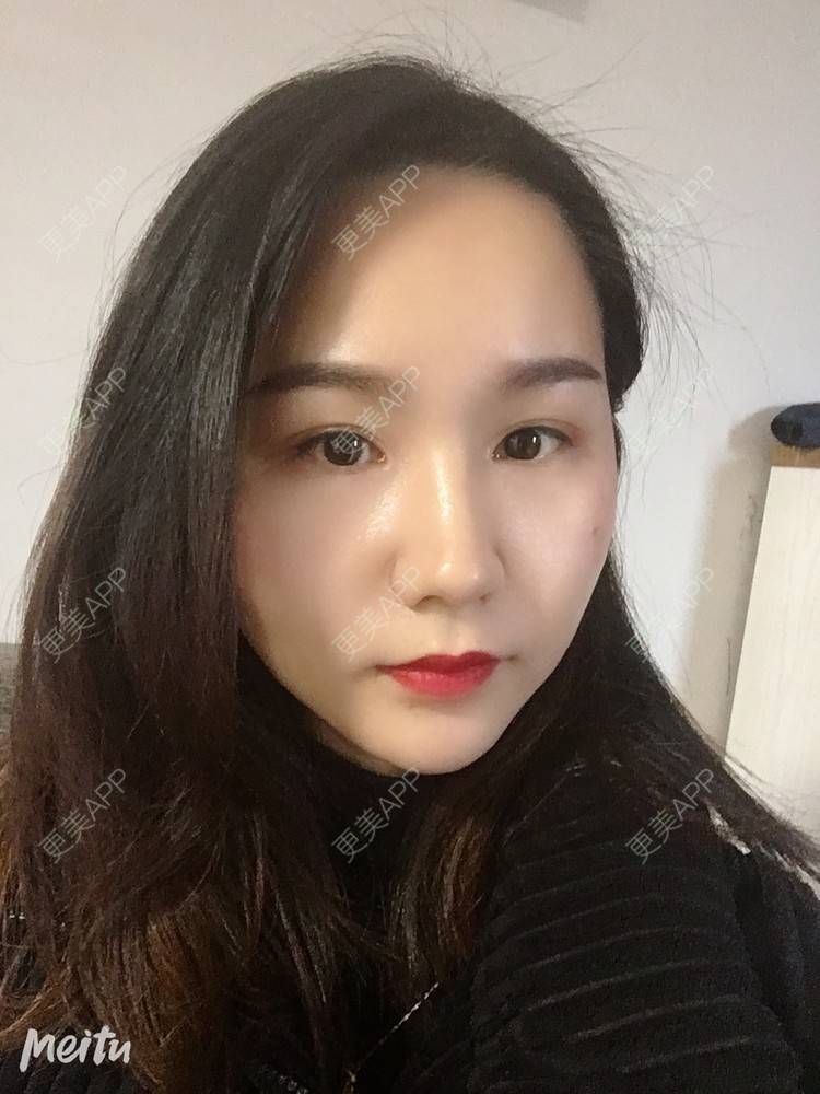 更美 - 怡你在这里吖的鼻部多项经验 | 耳软骨隆鼻 | 鼻翼缩小 | 鼻部多项 | 自体软骨垫鼻尖 | 重庆 | 鼻中隔软骨隆鼻