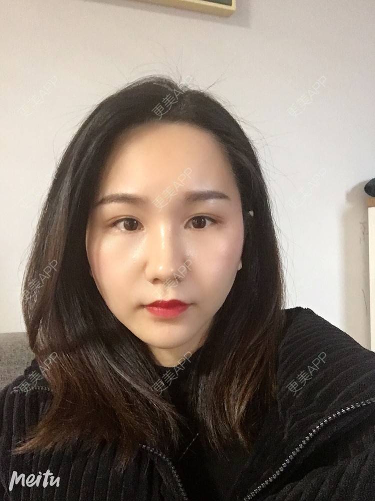 更美 - 怡你在这里吖的鼻部多项经验 | 耳软骨隆鼻 | 鼻翼缩小 | 鼻部多项 | 自体软骨垫鼻尖 | 重庆 | 鼻中隔软骨隆鼻